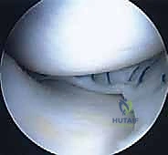 زراعة الغضروف الهلالي: استعادة وظيفة الركبة وحماية المفصل