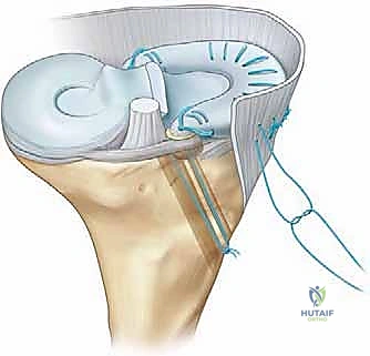صورة طبية: زراعة الغضروف الهلالي: استعادة وظيفة الركبة وحماية المفصل