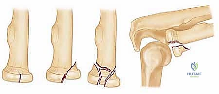 أعراض كسور رأس الكعبرة السريرية