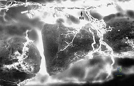 الميكانيكا الحيوية لحركة المرفق