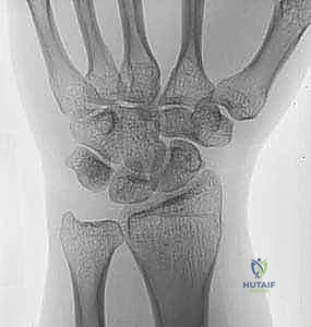 العلاج التحفظي وتأهيل المرفق