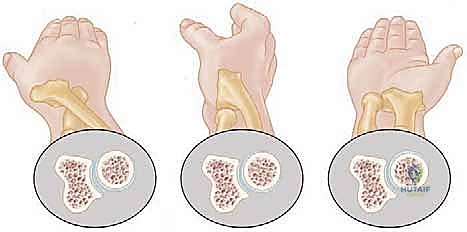 التشريح الدقيق لمفصل المرفق ورأس الكعبرة
