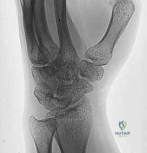 أهمية الحركة المبكرة بعد الكسر