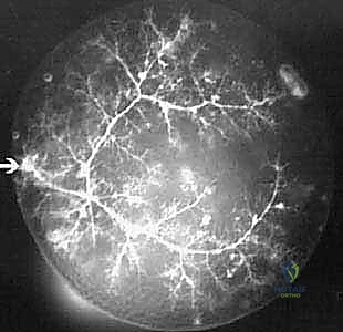 أسباب كسور المرفق وطرق الوقاية