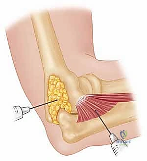 التثبيت الداخلي لكسور الكعبرة بالشرائح والمسامير