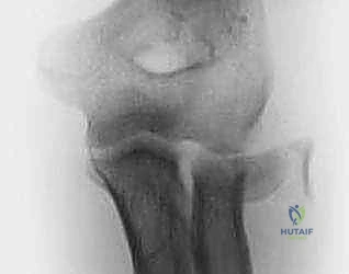 خيارات الجراحة المتقدمة للمرفق