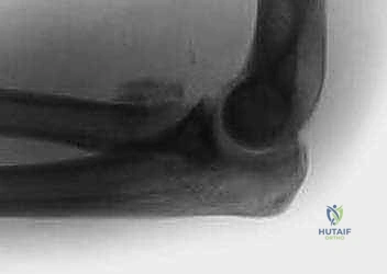 الشق الجراحي الدقيق وحماية الأعصاب