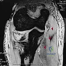 علاج كسور المرفق المعقدة في اليمن