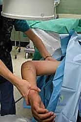 تأثير السقوط على اليد الممدودة