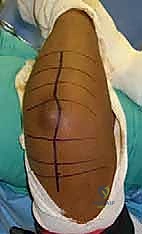 قراءة صور الأشعة لكسور المرفق