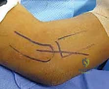 تنظيف المفصل وتثبيت الكسر