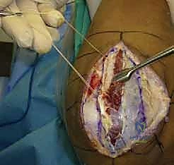 العودة للأنشطة الطبيعية بعد كسر الكعبرة