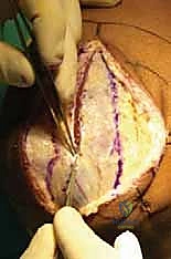 تصنيف ماسون لكسور رأس الكعبرة