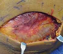 تقييم درجة الكسر وتحديد العلاج