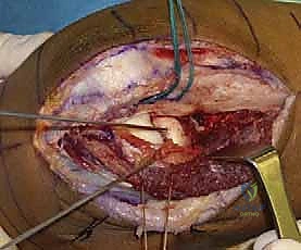 العلاج الطبيعي وتأهيل مفصل المرفق