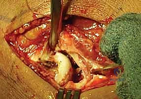 تثبيت الشرائح التيتانيوم بدقة