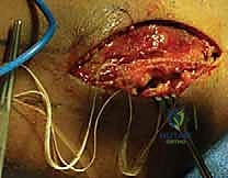 إغلاق الجرح بخياطة تجميلية