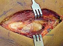 استخدام التقنيات الميكروسكوبية في الجراحة