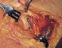 استبدال رأس الكعبرة بمفصل صناعي