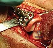 صورة توضيحية لـ كسور رأس وعنق الكعبرة بالمرفق التشخيص والعلاج مع الأستاذ الدكتور محمد هطيف