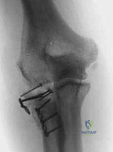 تمارين استعادة المدى الحركي للمرفق