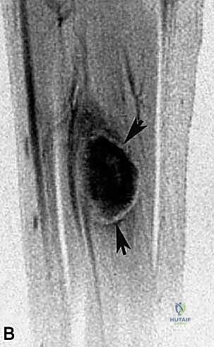 التشريح الدقيق والتقييم الأولي لورم ساركوما عضلة الساق