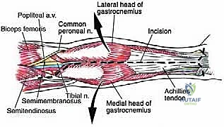 الفحص السريري الدقيق لتقييم حجم وامتداد الورم في عضلة الساق