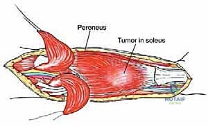 تصوير يوضح العلاقة بين الورم والهياكل العصبية والوعائية في الساق