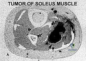 Masterclass in Wide Resection and Reconstruction of Soleus Muscle Sarcomas