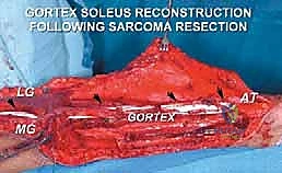 إعادة البناء الوظيفية باستخدام التقنيات المتقدمة وطعم Gore-Tex