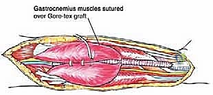 عملية الاستئصال الواسع للورم مع الحفاظ على الحواف السليمة