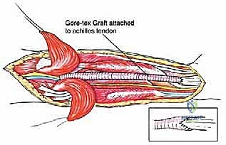 الشق الجراحي والتعريض الدقيق للعضلات الخلفية للساق