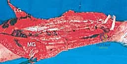 أخذ الخزعة والتخطيط الدقيق لمسار الاستئصال الجراحي