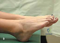 صورة توضيحية لـ ساركوما عضلة الساق: استئصال واسع وإعادة بناء متقدمة لاستعادة وظيفة الطرف