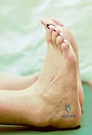 صورة توضيحية لـ ساركوما عضلة الساق: استئصال واسع وإعادة بناء متقدمة لاستعادة وظيفة الطرف