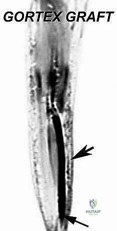 الأستاذ الدكتور محمد هطيف أثناء إجراء الجراحة الدقيقة
