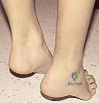 صورة توضيحية لـ ساركوما عضلة الساق: استئصال واسع وإعادة بناء متقدمة لاستعادة وظيفة الطرف