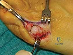 تثبيت العظم بالبراغي