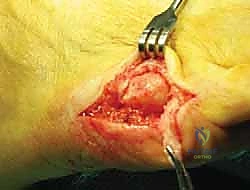 ورم إصبع القدم الصغير (Bunionette): دليلك الشامل للعلاج والتعافي مع الأستاذ الدكتور محمد هطيف