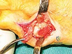 الحذاء الطبي بعد الجراحة