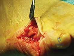 الخياطة التجميلية