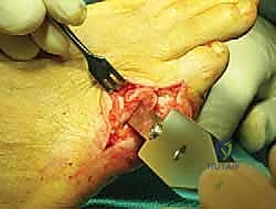 التشريح العظمي للقدم