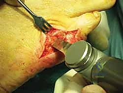 تشخيص ورم إصبع القدم الصغير