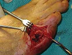 متابعة التئام العظم