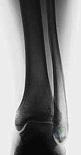 متابعة التئام العظام بعد العملية