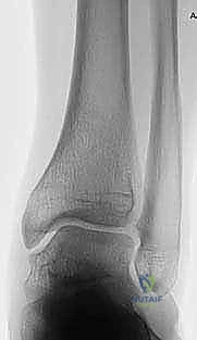 تطور حالة المريض بعد أشهر من الجراحة