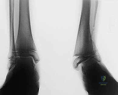 الدقة في تعديل المحور الميكانيكي للساق