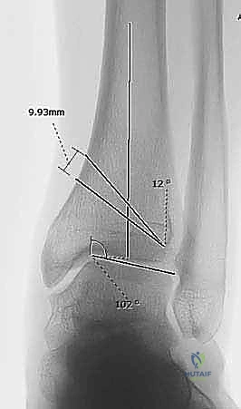 الوقاية من مضاعفات جراحة الكاحل