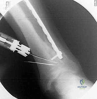 نتائج مبهرة لمرضى الدكتور محمد هطيف