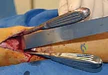 أسباب تشوهات الكاحل المعقدة